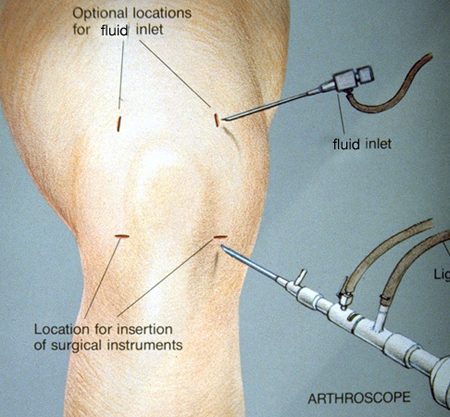 Meniscus Tear Swelling