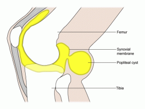 meniscus tear signs